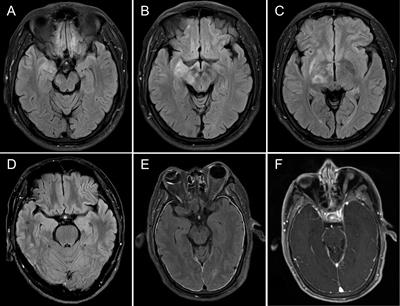 Autoimmune encephalitis with mGluR5 antibodies: A case series from China and review of the literature